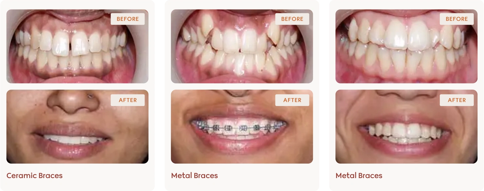 Befor and after Bg 2