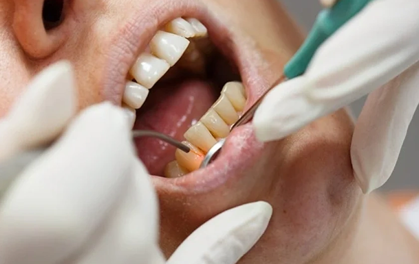Hard Tissue Laser