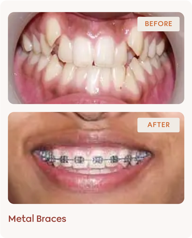 Metal braces before and after