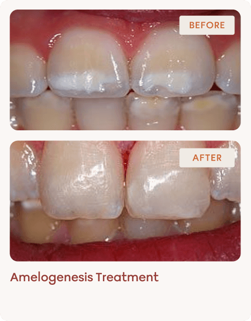 Amelogenesis Treatment 1
