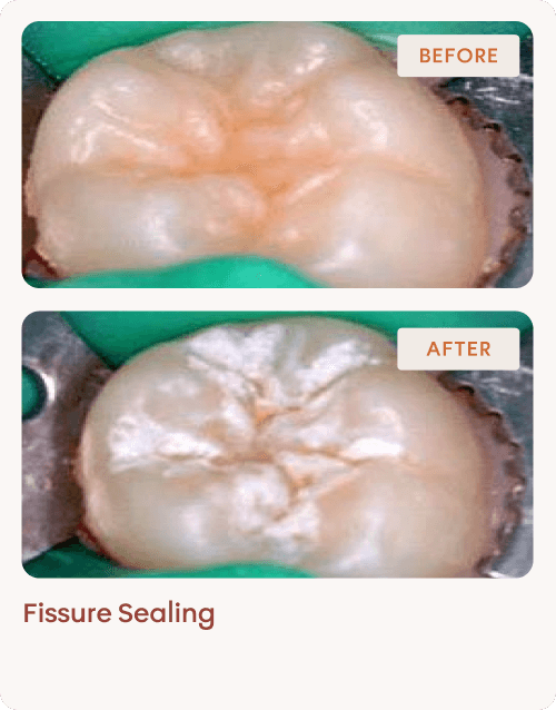 Amelogenesis Treatment