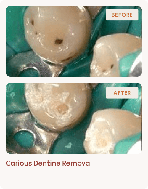 Carious Dentine Removal