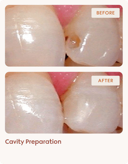 Cavity Preparation 2