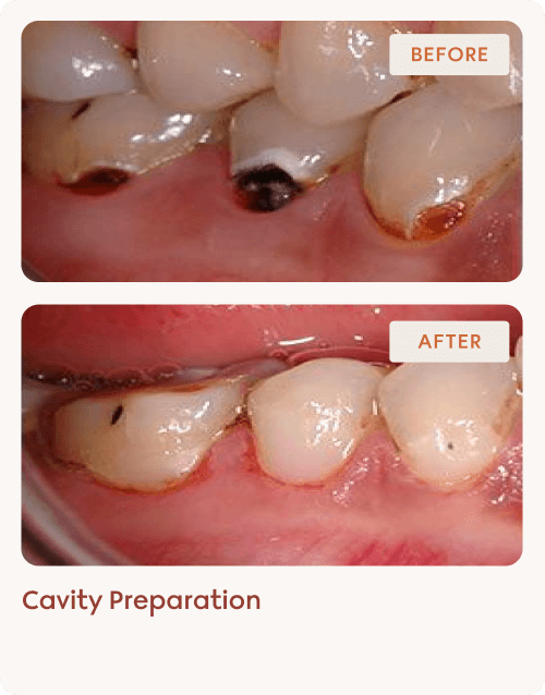 Cavity Preparation