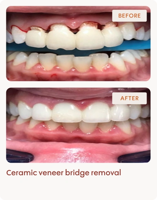 Ceramic veneer bridge removal 1