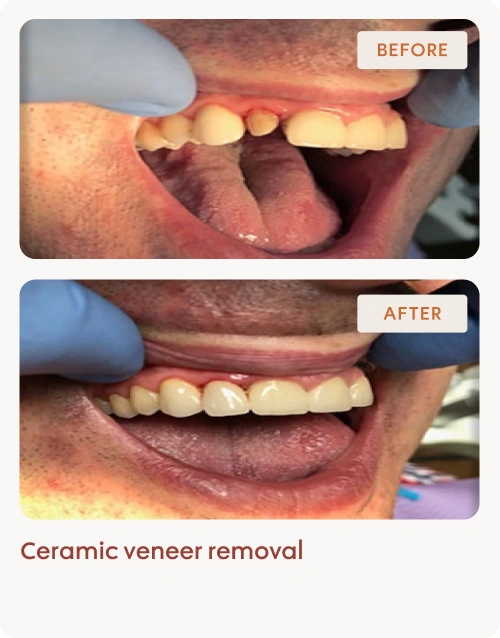 Ceramic veneer removal