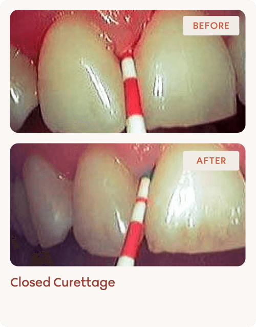 Closed Curettage