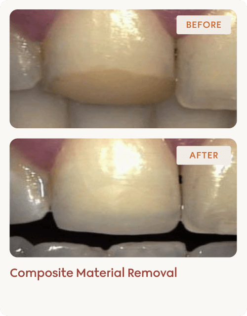 Composite Material Removal