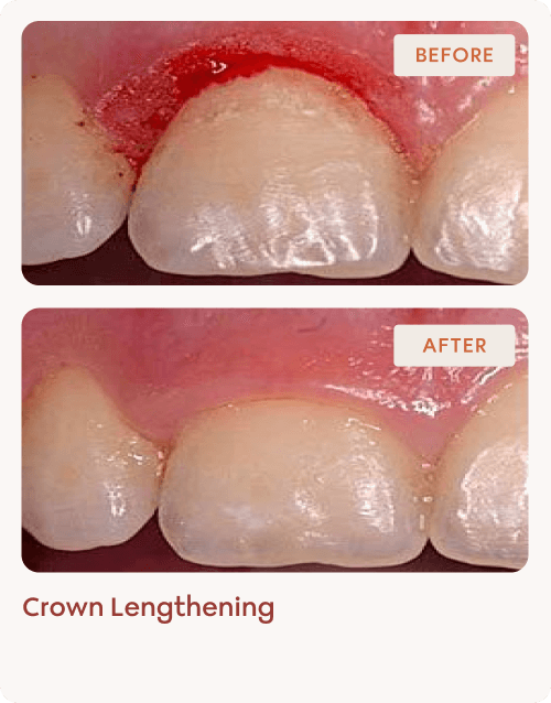 Crown Lengthening