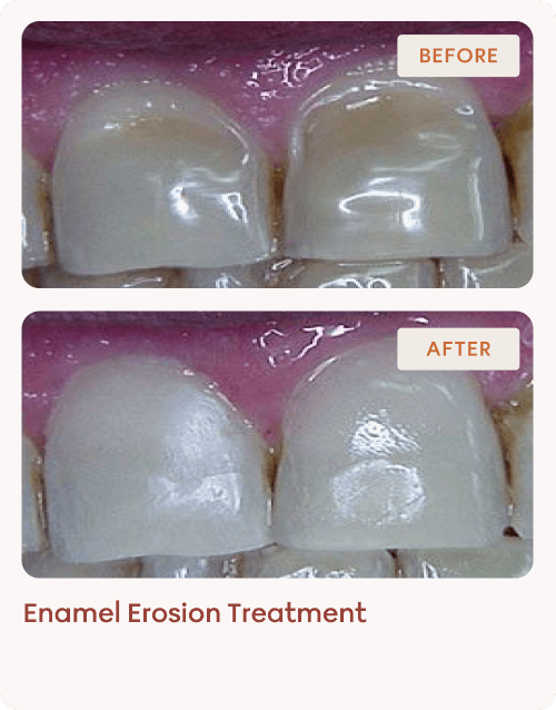 Enamel Erosion Treatment