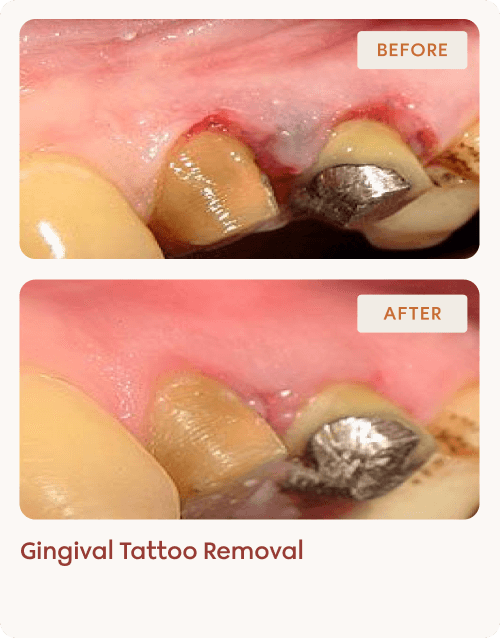 Gingival Tattoo Removal