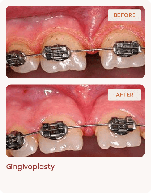 Gingivoplasty before and after