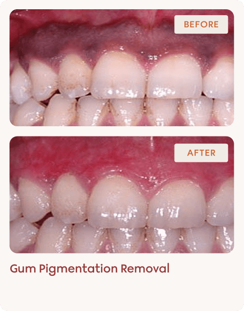 Gum Pigmentation Removal