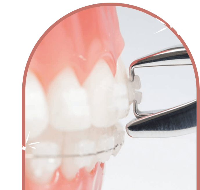 Laser-Assisted Ceramic Debonding