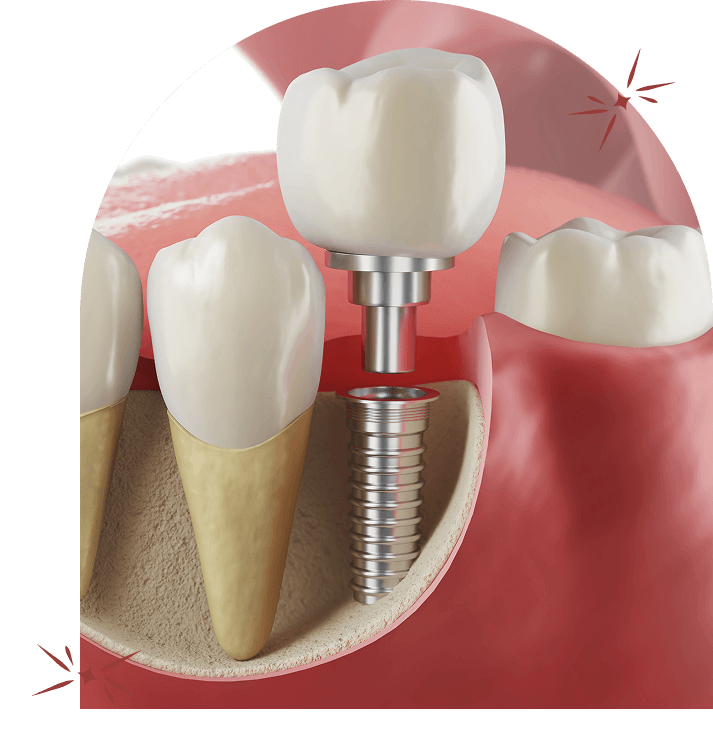 Dental implants in bangalore