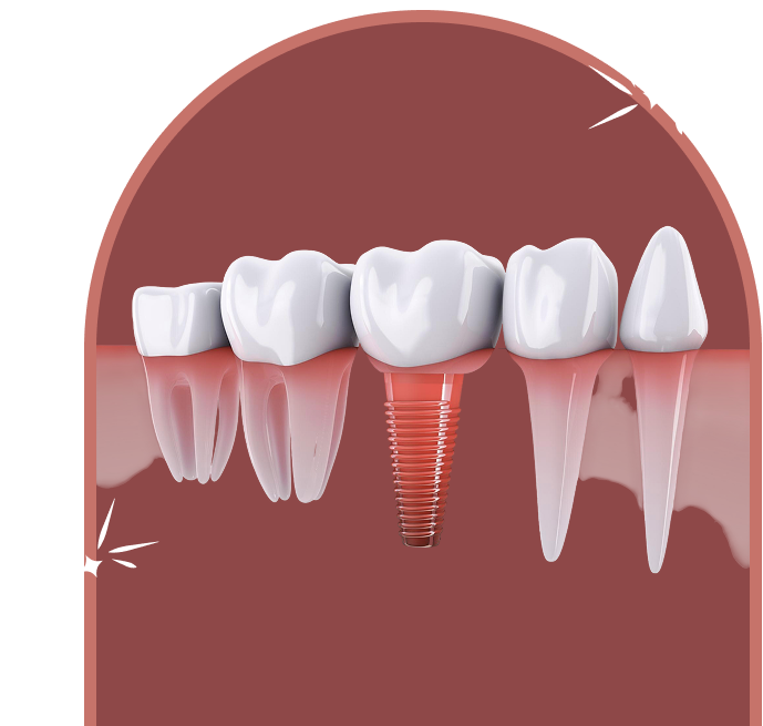 Peri-Implantitis