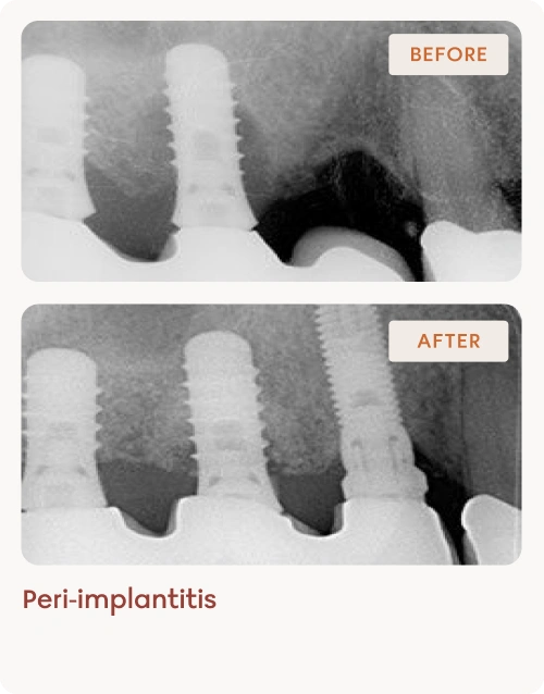 Peri-implantitis-before-after