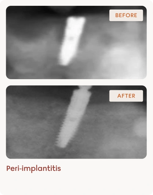 Peri-implantitis-results 2