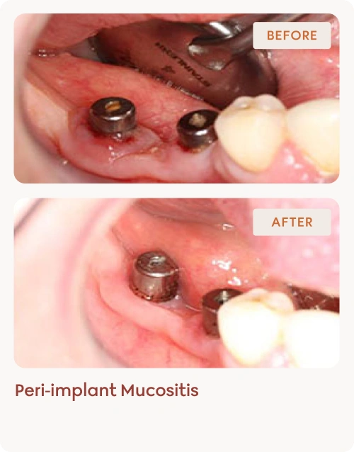 Peri-implantitis-results 3