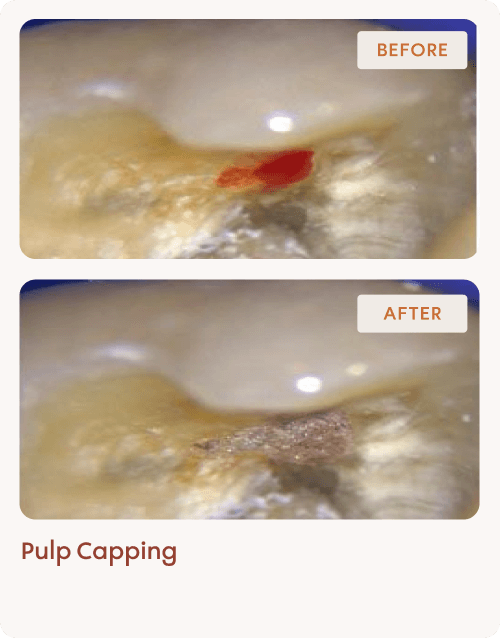 Pulp Capping