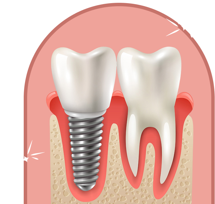 Implantology
