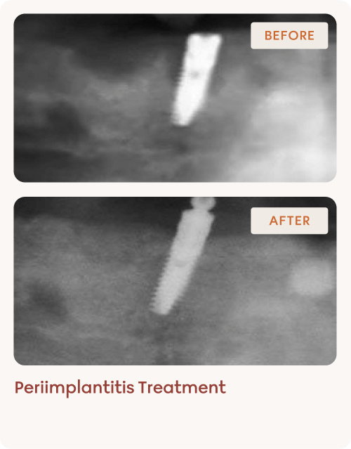 Implantology-img-5 (1)