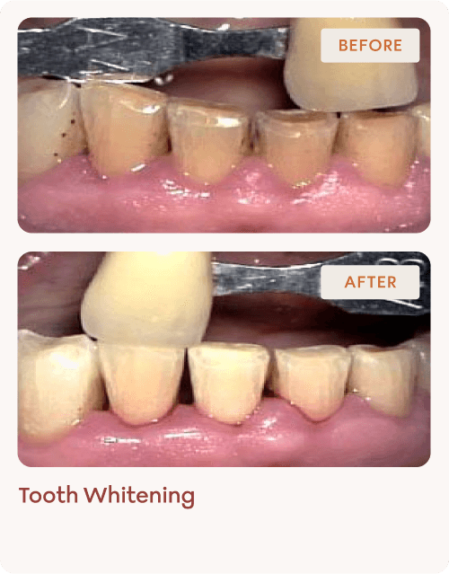 Tooth-Whitening-img-3 (1)