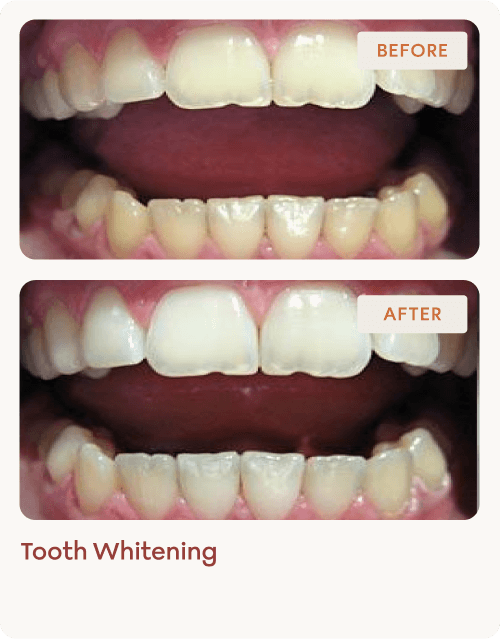 Tooth-Whitening-img-4 (1)