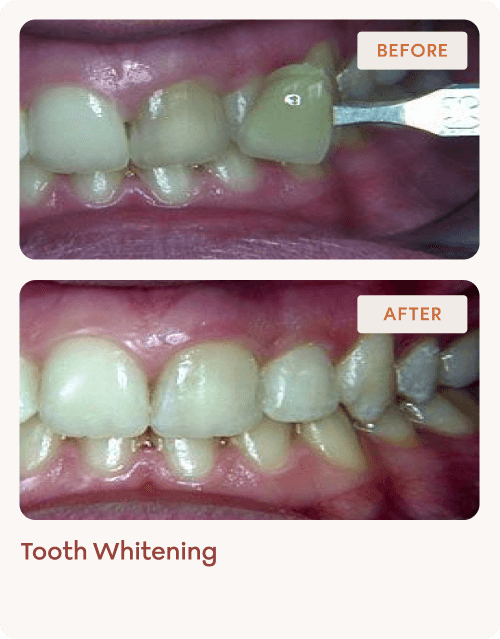 Tooth-Whitening-img-5 (1)