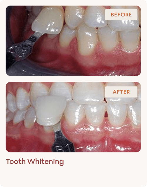 Tooth-Whitening-img-6 (1)