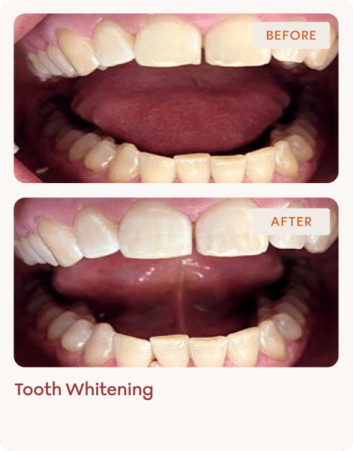 Tooth-Whitening-img-7 (1)
