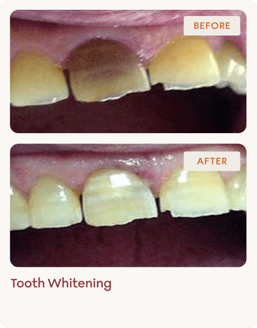 Tooth-Whitening-img-8 (1)