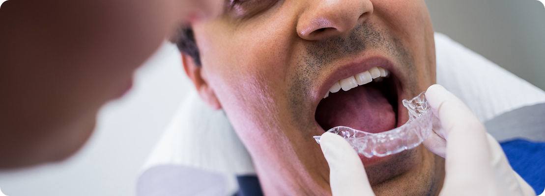 Invisible Braces for Adults